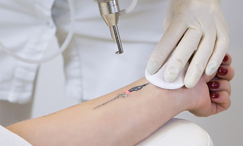 Laser Tattoo Removal 